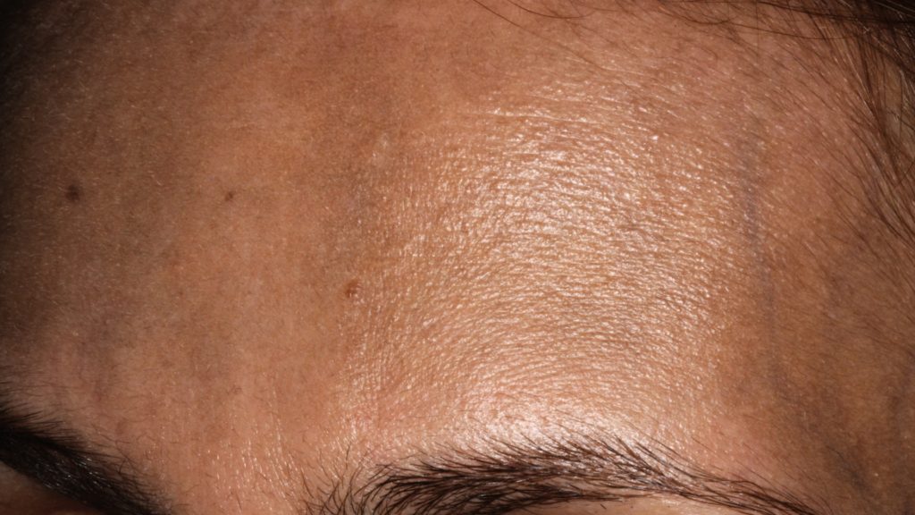 forehead hyperpigmentation-Sarah's-Quest