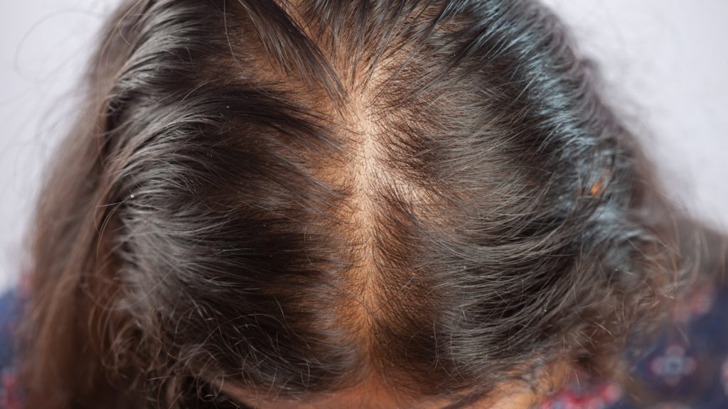 Androgenetic-Alopecia-Sarah's-Quest