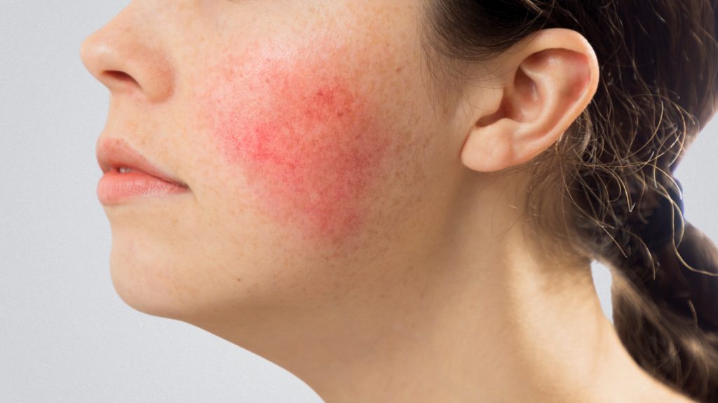 azelaic-acid-for-acne-darkspots-rosacea-Sarah's-Quest