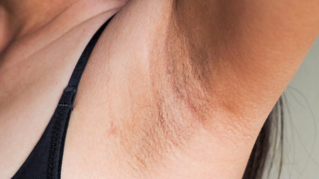 dark-underarms-Sarah's-Quest
